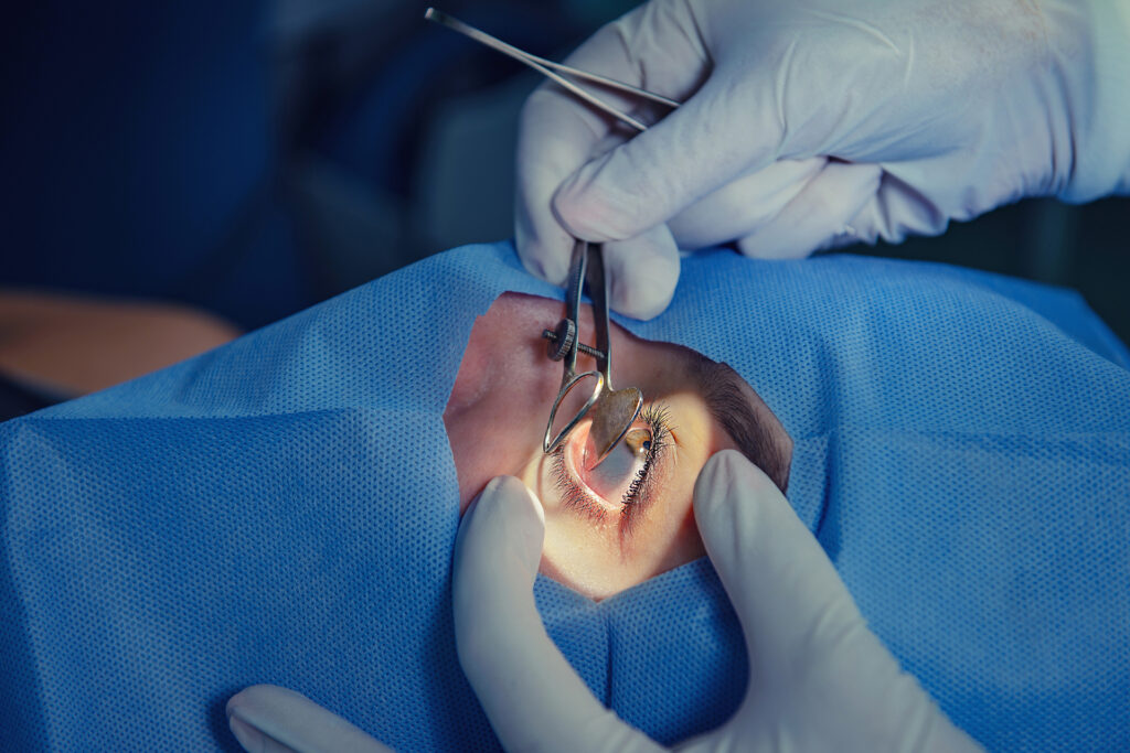 Close-up of cataract surgery with gloved hands using microsurgical instruments on a patient’s eye under a sterile drape.