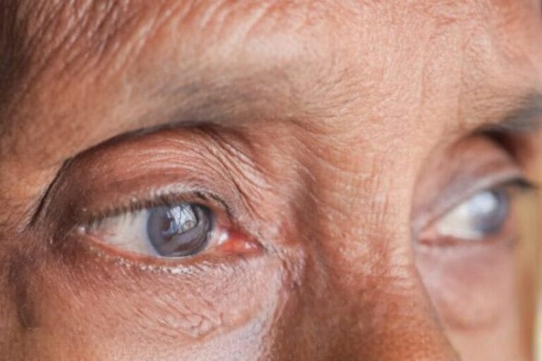 Close-up of elderly woman’s eyes showing cataract