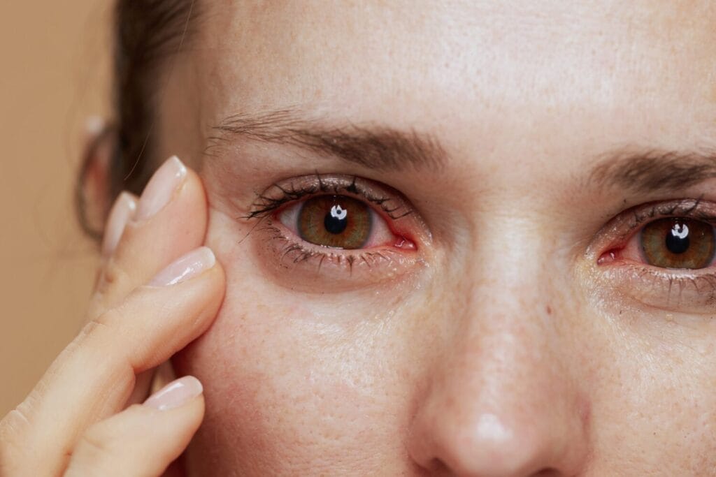 Close-up of a woman with red, irritated eyes gently pulling down her lower eyelid, suggesting eye inflammation or infection.